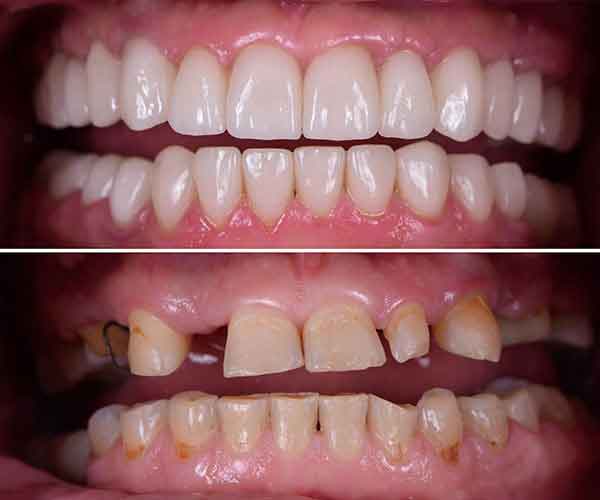 Full Mouth Restoration